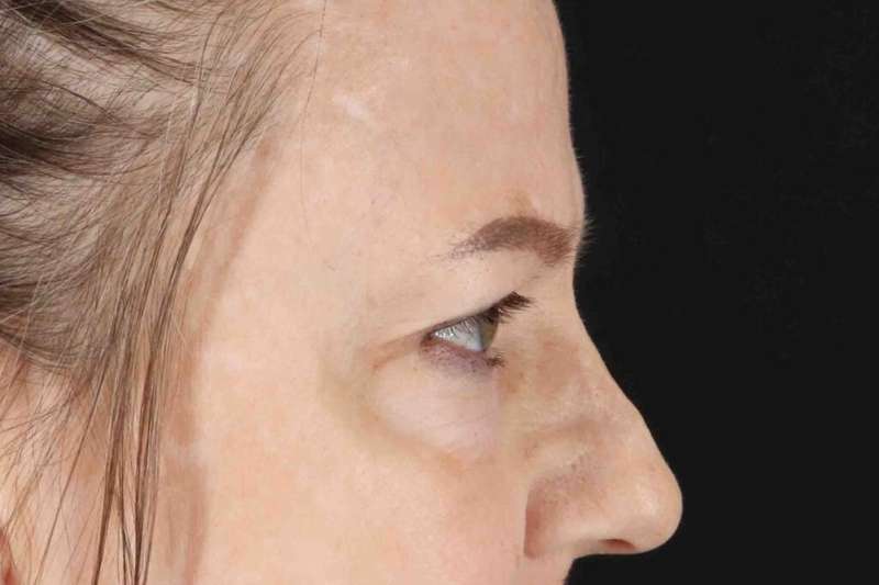Blepharoplasty (Eyelid Surgery) Before & After Patient #4525