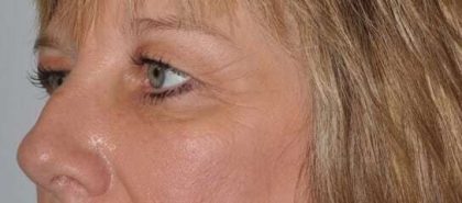 Blepharoplasty (Eyelid Surgery) Before & After Patient #4546
