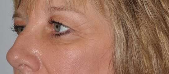 Blepharoplasty (Eyelid Surgery) Before & After Patient #4546