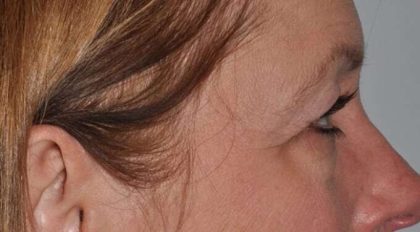 Blepharoplasty (Eyelid Surgery) Before & After Patient #4553