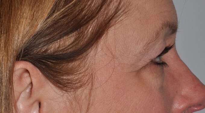 Blepharoplasty (Eyelid Surgery) Before & After Patient #4553