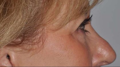 Blepharoplasty (Eyelid Surgery) Before & After Patient #4560