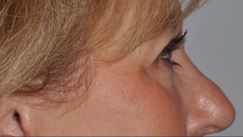 Blepharoplasty (Eyelid Surgery) Before & After Patient #4560