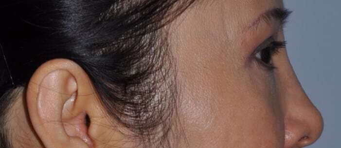 Blepharoplasty (Eyelid Surgery) Before & After Patient #4567