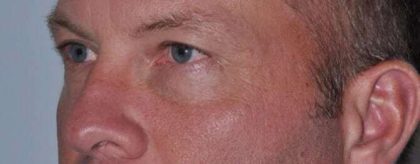 Blepharoplasty (Eyelid Surgery) Before & After Patient #4574