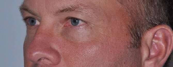 Blepharoplasty (Eyelid Surgery) Before & After Patient #4574