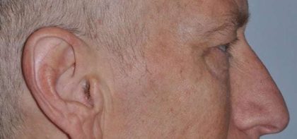 Blepharoplasty (Eyelid Surgery) Before & After Patient #4581