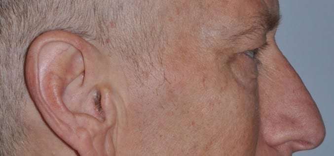 Blepharoplasty (Eyelid Surgery) Before & After Patient #4581