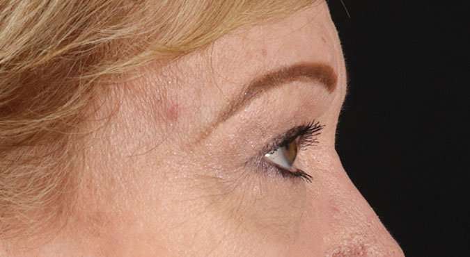 Blepharoplasty (Eyelid Surgery) Before & After Patient #4588