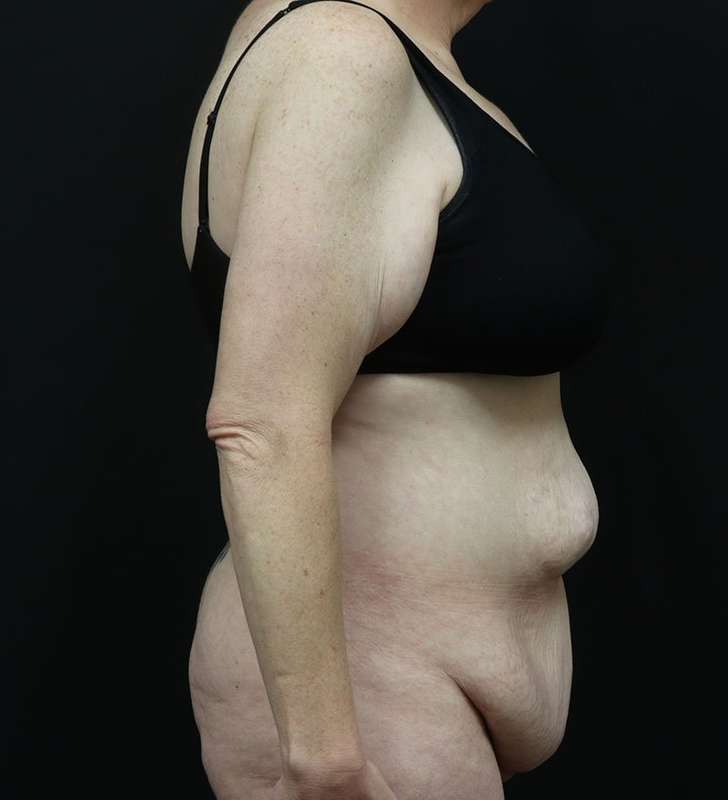 Abdominoplasty (Tummy Tuck) Before & After Patient #948