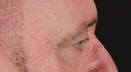 Blepharoplasty (Eyelid Surgery) Before & After Patient #4599