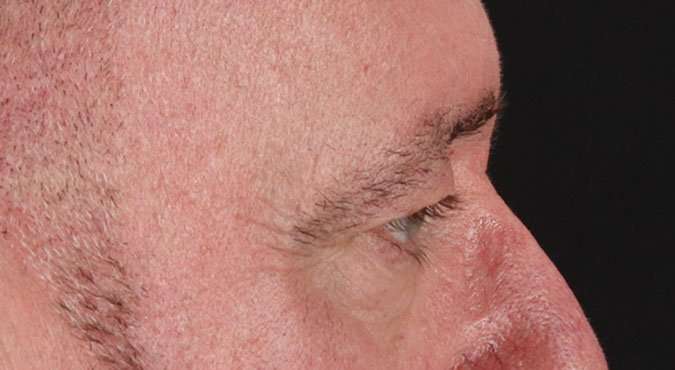 Blepharoplasty (Eyelid Surgery) Before & After Patient #4599