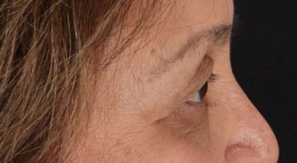 Blepharoplasty (Eyelid Surgery) Before & After Patient #4649