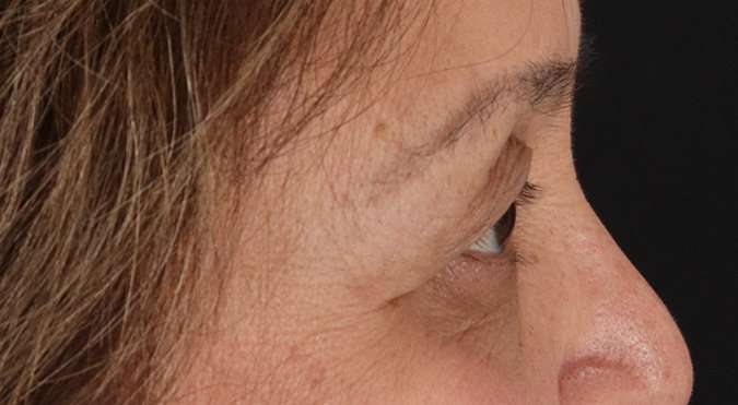 Blepharoplasty (Eyelid Surgery) Before & After Patient #4649
