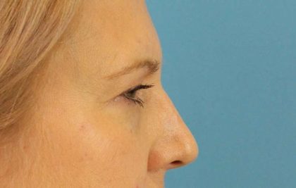 Brow Lift Before & After Patient #4672
