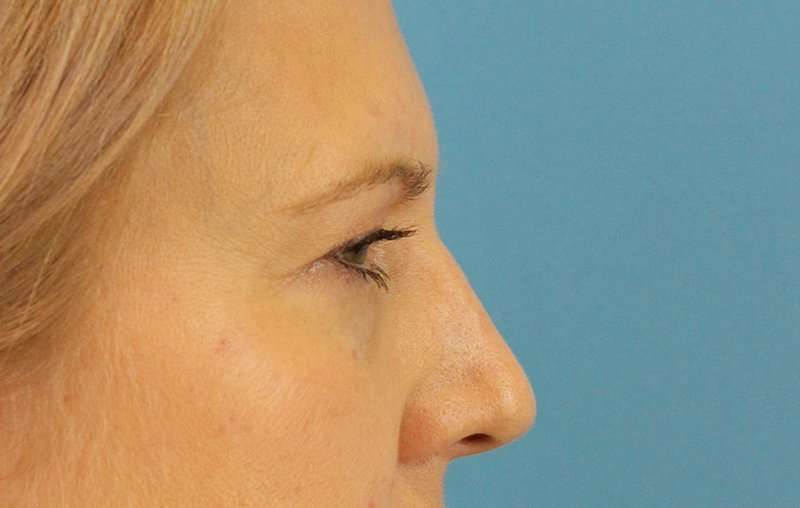 Brow Lift Before & After Patient #4672
