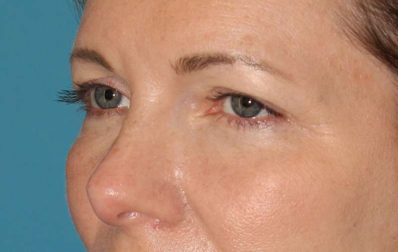 Brow Lift Before & After Patient #4679