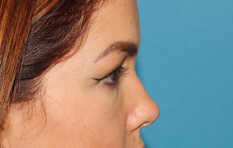 Brow Lift Before & After Patient #4690