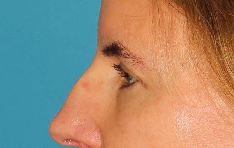 Brow Lift Before & After Patient #4697