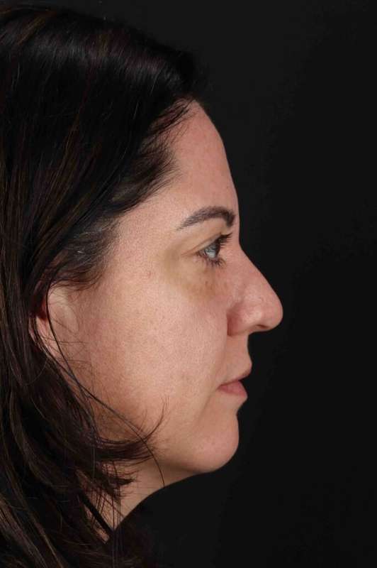 Brow Lift Before & After Patient #4733
