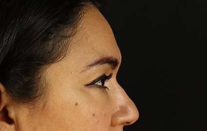 Brow Lift Before & After Patient #4744