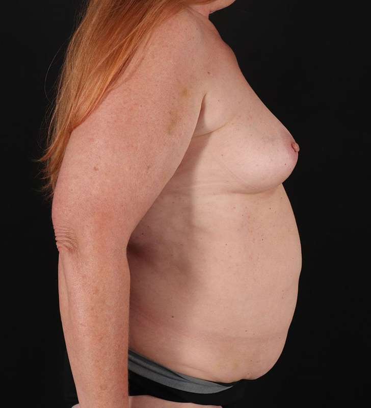 Abdominoplasty (Tummy Tuck) Before & After Patient #962