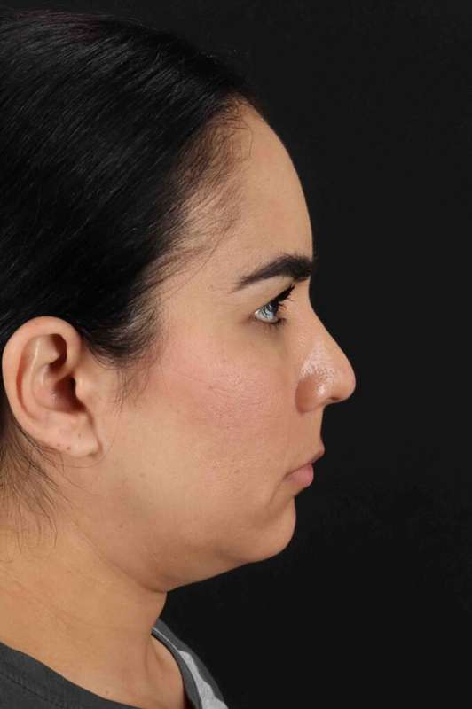 Brow Lift Before & After Patient #4755
