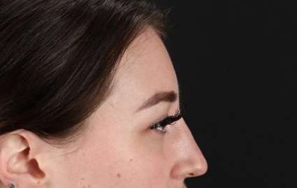Brow Lift Before & After Patient #4766