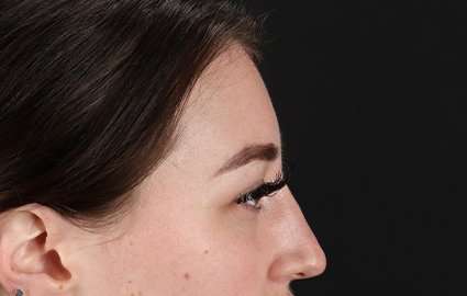 Brow Lift Before & After Patient #4766