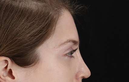 Brow Lift Before & After Patient #4777