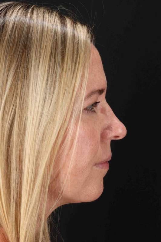 Brow Lift Before & After Patient #4810