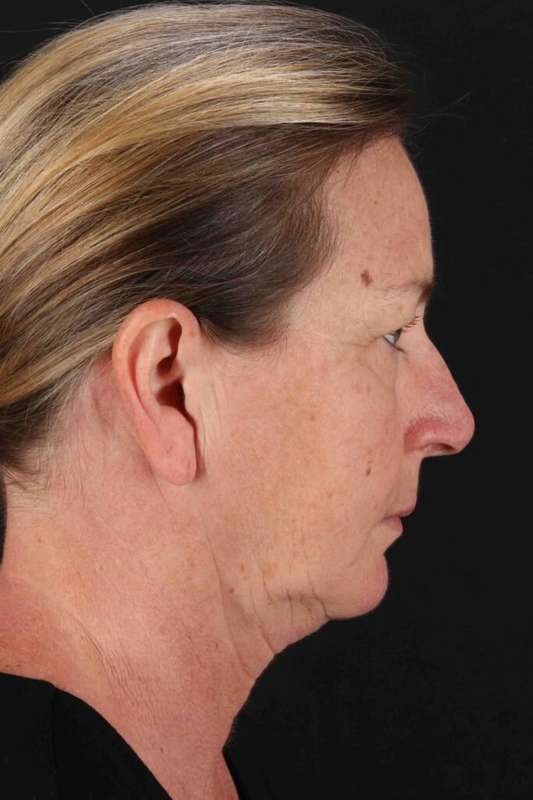Brow Lift Before & After Patient #4832
