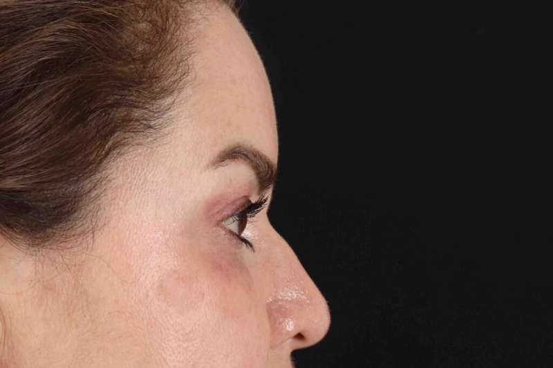 Brow Lift Before & After Patient #4843