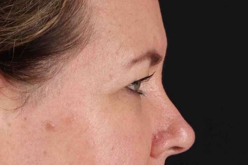 Brow Lift Before & After Patient #4865