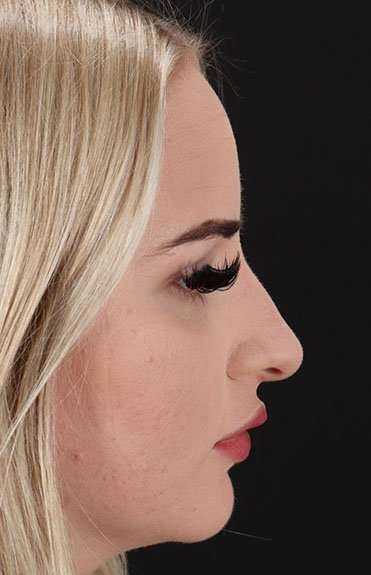 Brow Lift Before & After Patient #4876