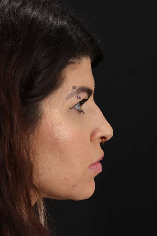 Brow Lift Before & After Patient #4912