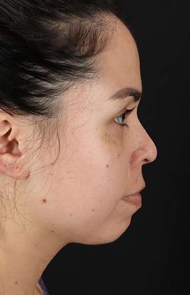 Cosmetic Injectables Before & After Patient #4990