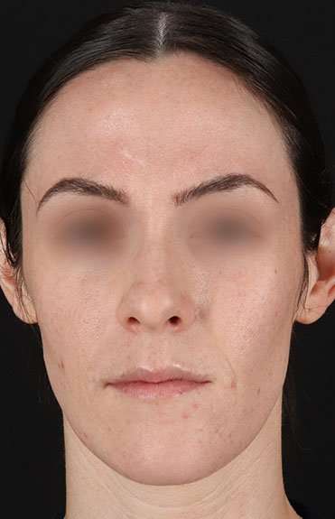 Cosmetic Injectables Before & After Patient #5016
