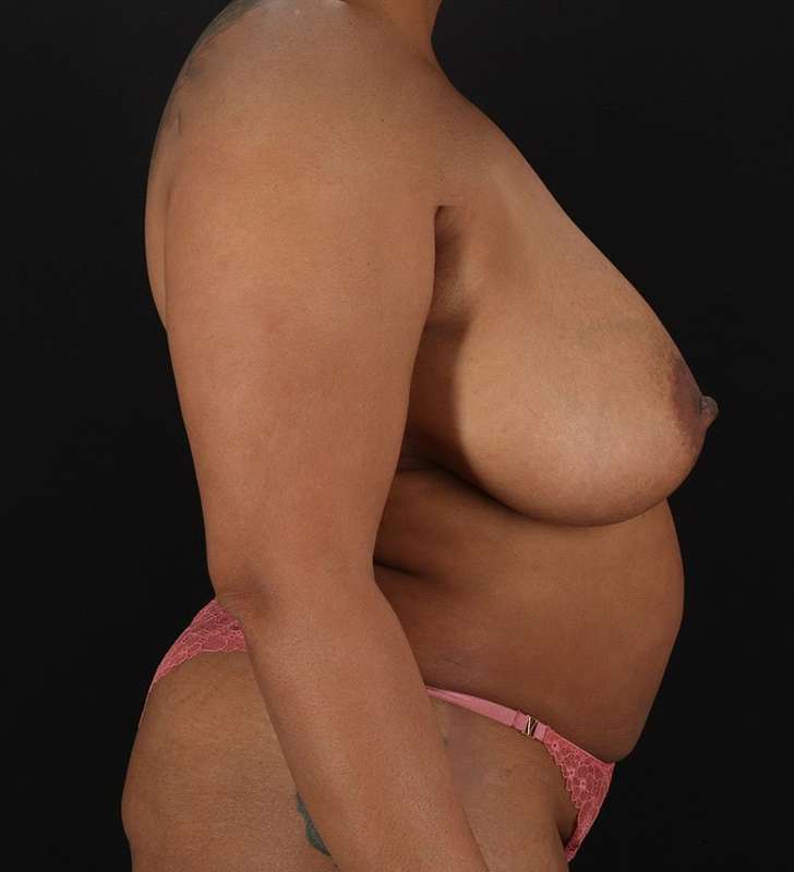 Abdominoplasty (Tummy Tuck) Before & After Patient #990