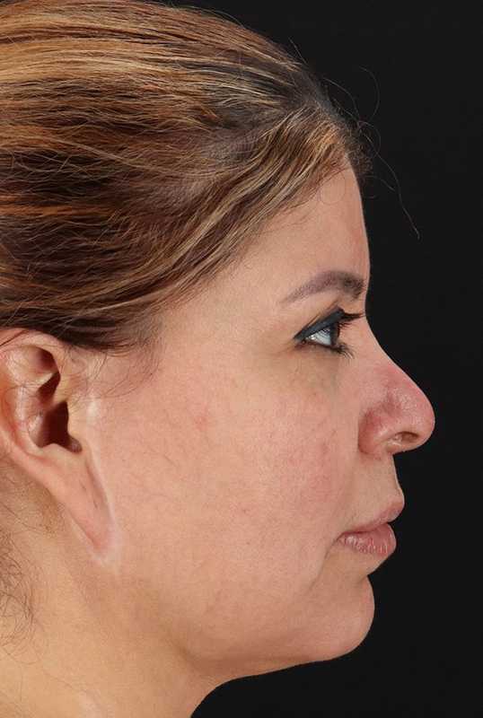 Facelift Before & After Patient #5108