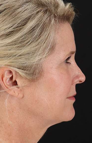 Facelift Before & After Patient #5229