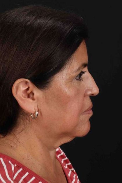 Facelift Before & After Patient #5284