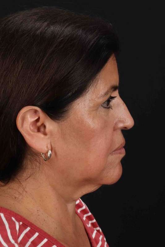 Facelift Before & After Patient #5284