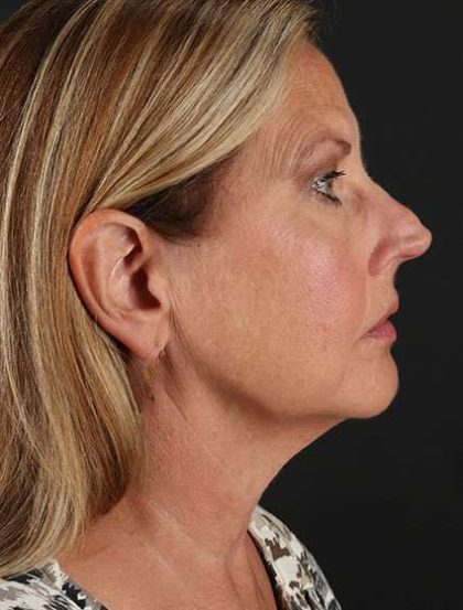 Facelift Before & After Patient #5348