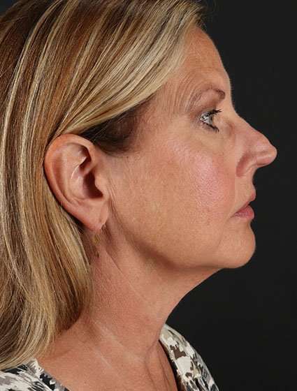 Facelift Before & After Patient #5348