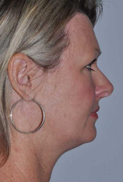 Facelift Before & After Patient #5385