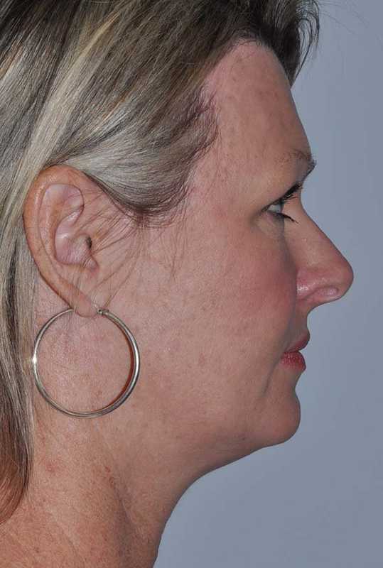 Facelift Before & After Patient #5385