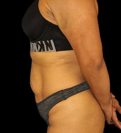 Abdominoplasty (Tummy Tuck) Before & After Patient #601