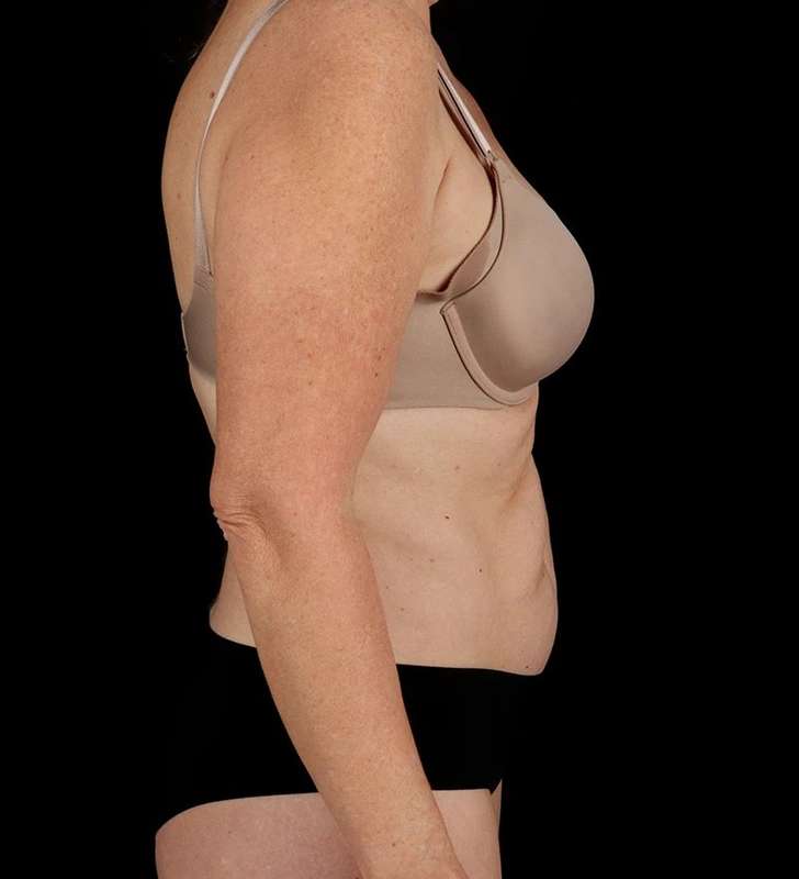 Abdominoplasty (Tummy Tuck) Before & After Patient #1029