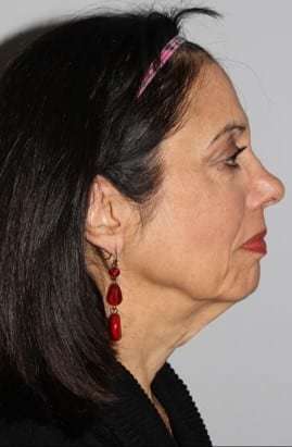 Facelift Before & After Patient #5399